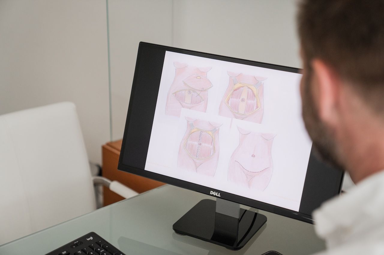 Aufklärung und Untersuchung vor einer Bauchdeckenstraffung in der Praxis Klinik Pöseldorf