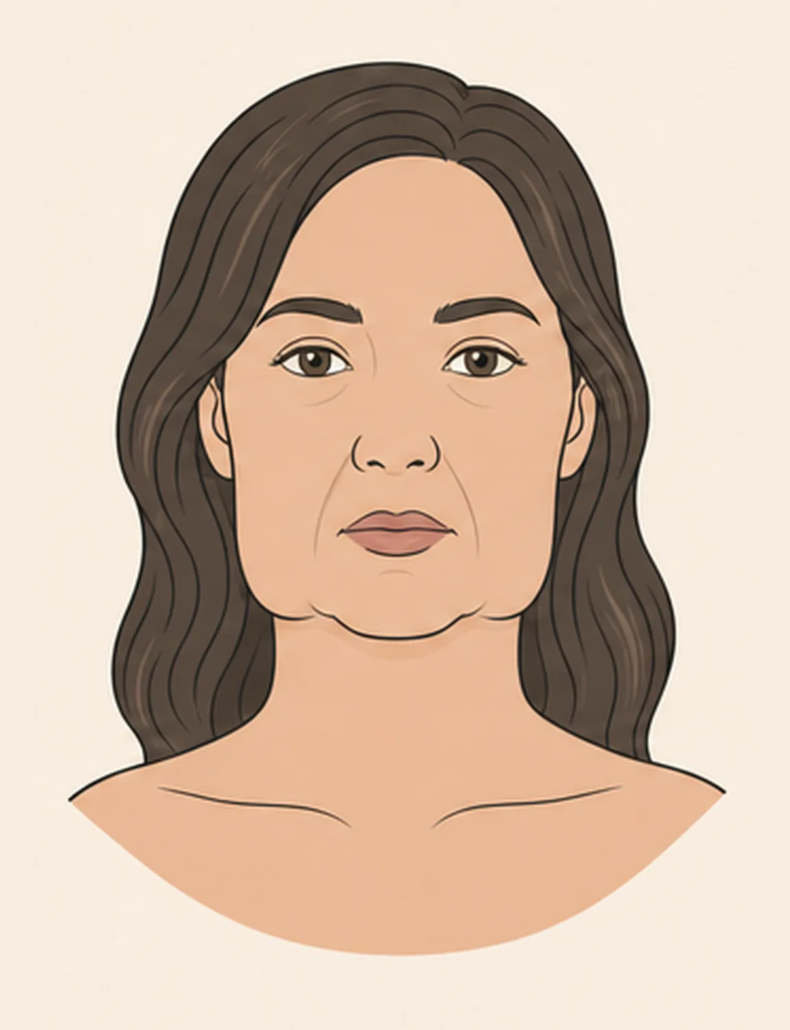 Dasselbe Gesicht: über dem Unterkiefer hängt beidseits Gewebe herab, die Kieferkontur ist unterbrochen und das Gesicht unten am breitesten. Wangen und Hals sind unverändert straff.